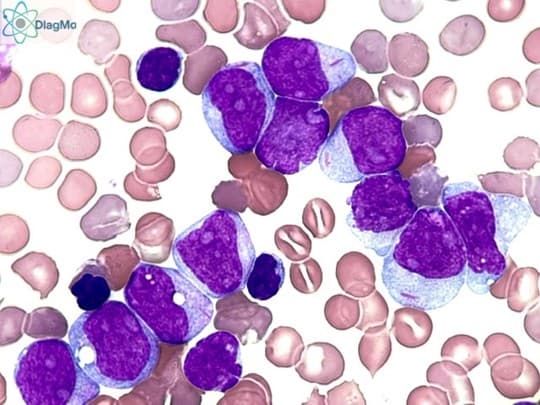 Diagnóstico Integral de Leucemia Mieloide Aguda